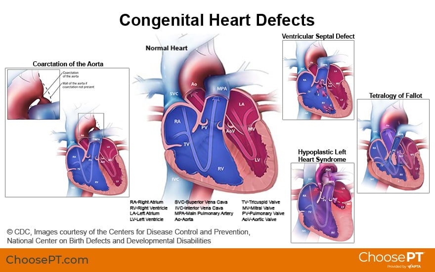 Illustration of congenital heart defects