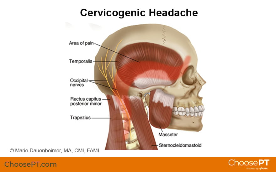 Illustration of cervicogenic headaches